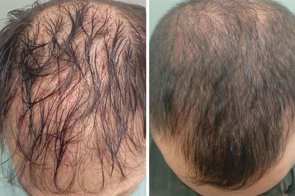 edmonton hair restoration