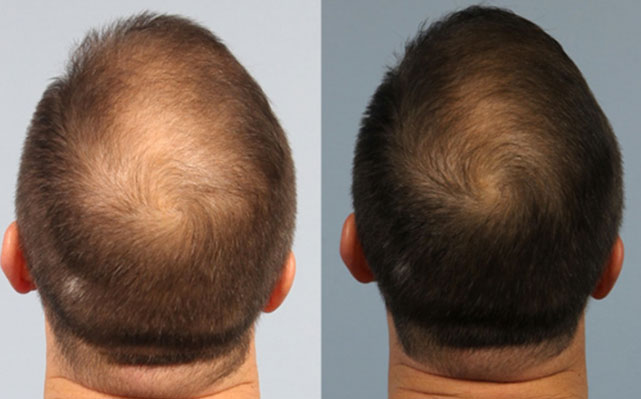 hair loss treatment edmonton